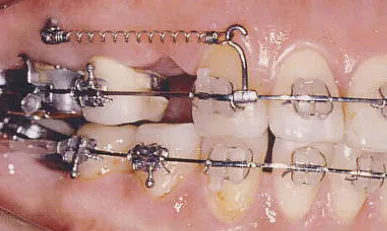 Mini-Implant Anchorage
